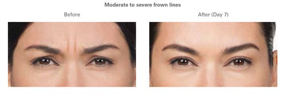 Botox Before and After Frown Lines