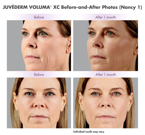 juvederm-voluma-before-and-after