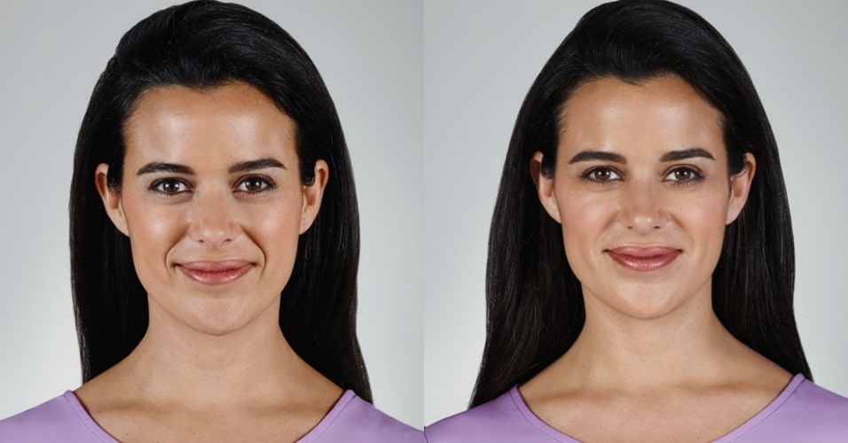 Vollure-before-after-nasolabial-folds